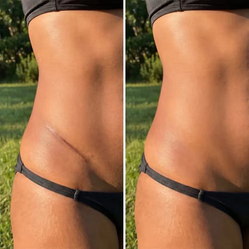 Résultat cliente sur une cicatrice abdominale