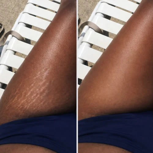 Résultat cliente sur les cuisses